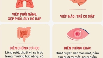 Ca bệnh ho gà tại Hà Nội tăng cao