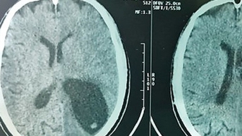 Sán dây lợn làm tổ trong não người đàn ông ở Nghệ An