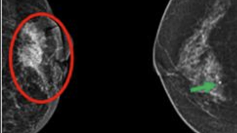 Tưởng u gan, hóa ung thư vú di căn