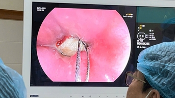 Cứu sống nam thanh niên nhập viện vì bị hóc xương heo