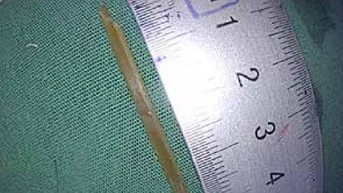 Ăn lẩu bị nhánh sả dài 3,5 cm… cắm sâu thành dạ dày