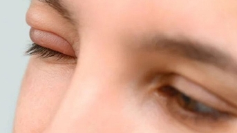 Bị lẹo mắt, làm sao để mau khỏi?