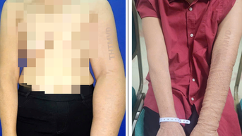 Giải phóng cho người phụ nữ bị phù tay voi sau phẫu thuật ung thư vú