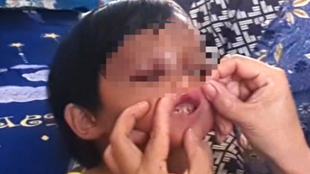 Vụ bé gái 4 tuổi nghi bị cha nuôi bạo hành: Đánh con bằng chổi cán nhựa