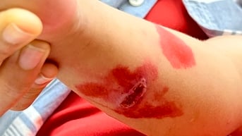 Nhiều trẻ bị chốc nặng do cha mẹ tự chữa tại nhà