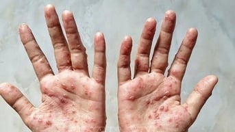 Người đàn ông ở Cà Mau mắc đậu mùa khỉ