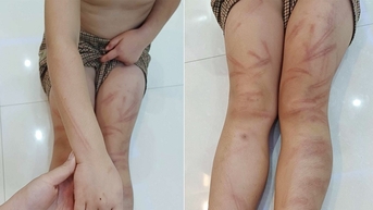 Làm rõ vụ việc 6 trẻ mầm non bị đánh bầm tím khắp cơ thể