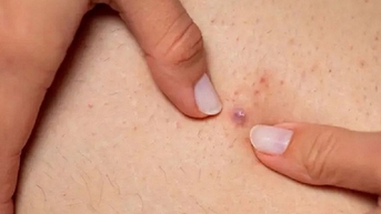 3 vấn đề trên da dễ tưởng nhầm là mụn nhưng không phải