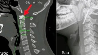 Phẫu thuật nội soi điều trị thành công ca gãy cột sống cổ phức tạp