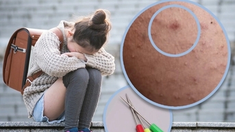 Bé gái Trung Quốc nghi bị bạn học dùng dùi khâu đâm vào chân cả trăm nhát