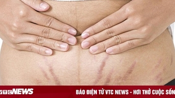 Cách chăm sóc da bụng sau khi sinh
