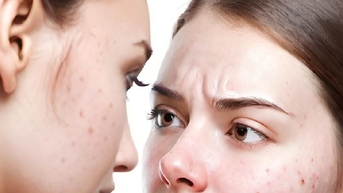 4 vấn đề sức khỏe tiềm ẩn có dấu hiệu cảnh báo là mụn trứng cá