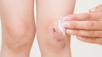 Tại sao vết thương người bệnh tiểu đường lâu lành?