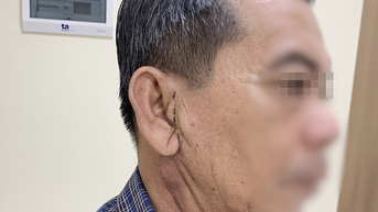 Mổ khối u ở mang tai tránh liệt mặt cho bệnh nhân