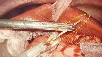 Sau 1 tháng ăn cá, nam thanh niên được phát hiện áp xe tụy do xương cá