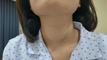 Phát hiện cường giáp từ dấu hiệu khó thở, tim đập nhanh