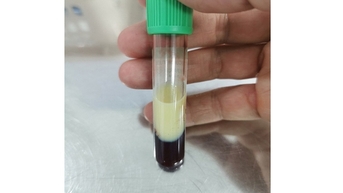 Viêm tụy cấp do mỡ máu 'đông đặc'