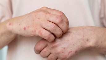Mưa to, ngập nước, bác sĩ khuyến cáo các bệnh ngoài da