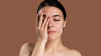 Căng thẳng làm nổi mụn