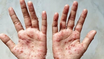 Cà Mau có ca nghi mắc đậu mùa khỉ đầu tiên