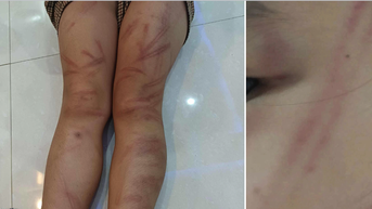 Sở Giáo dục và Đào tạo Nghệ An yêu cầu báo cáo vụ nhiều trẻ 5 tuổi nghi bị bạn đánh