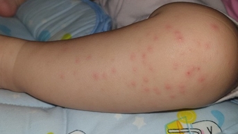 Bệnh tay chân miệng vào mùa, có nhiều ca biến chứng nặng