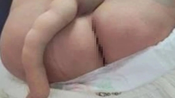 Bé trai 4 tháng tuổi có 'đuôi' dài 14 cm