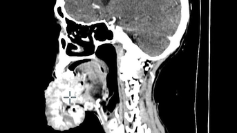 Ăn thực dưỡng chữa ung thư, khối u di căn từ môi xuống hàm