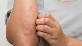 Cẩn trọng với các bệnh viêm da trong mùa mưa lũ