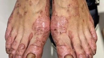 Phát ban, ngứa rỉ nước tay chân do viêm da cơ địa