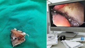 Gây mê, gắp 3 chiếc răng giả mắc kẹt ở thực quản bệnh nhân