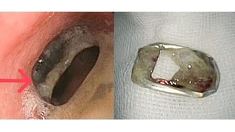 Ho khan 3 tháng, đi khám phát hiện khoen khóa lon bia kẹt trong phổi
