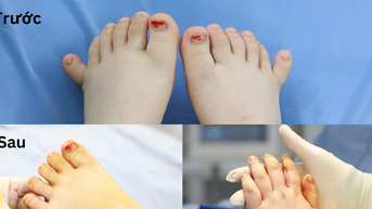 Một bệnh nhi có dị tật thừa 4 ngón tay và chân hiếm gặp