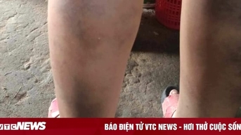Nam sinh lớp 6 ở Quảng Nam bị cô giáo đánh bầm tím 2 chân
