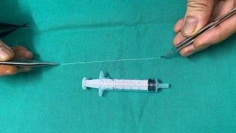 Phẫu thuật gắp con giun dài 14cm trong mắt bệnh nhân