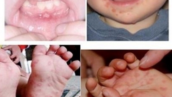 Tăng cường khuyến cáo phòng ngừa bệnh tay chân miệng