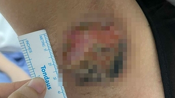 Nhiều ca hoại tử, cháy đen nách do đốt điện trị hôi nách ở spa