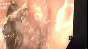 Người phụ nữ 49 tuổi có hàng trăm con giun trong đường tiêu hóa