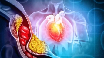 Dấu hiệu cholesterol cao đã chuyển thành bệnh nguy hiểm