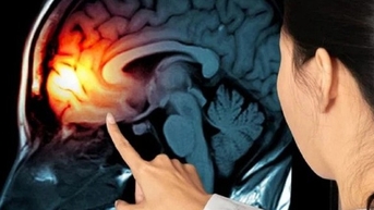 Phát hiện thuốc có thể ngăn ngừa ung thư não