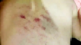 Học sinh lớp 1 bị giáo viên đánh bầm tím người