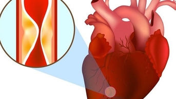 Bệnh nhân bị nhồi máu cơ tim cấp may mắn được cứu sống nhờ nhanh chóng làm việc này