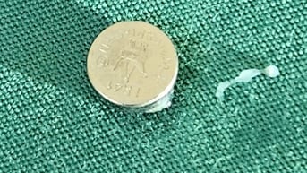 Trong lúc chơi đùa, bé 5 tuổi nuốt viên pin xuống dạ dày