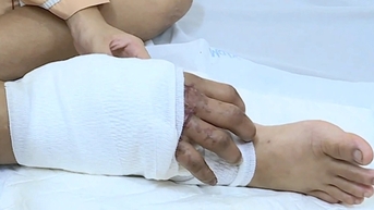 Khi nào mổ tiếp cho cô gái mang thai được ghép tạm tay đứt lìa vào chân?