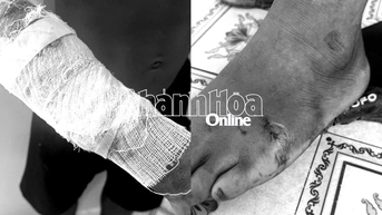 Cá sấu sổng chuồng tấn công nam thanh niên gây thương tích