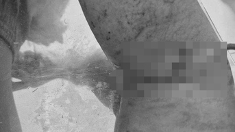 Nối thành công động mạch cánh tay cho bệnh nhân ở Phú Quốc