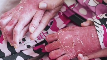 Psoriasis៖ ការឈឺចាប់ទាំងផ្លូវកាយ និងផ្លូវចិត្តរបស់ប្រជាជនវៀតណាមរាប់ពាន់នាក់។