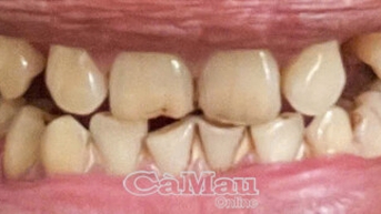Thuốc lá gây nhiều bệnh lý về răng miệng