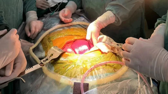 Trung Quốc thành công ghép gan lợn chỉnh sửa gene đầu tiên trên người sống