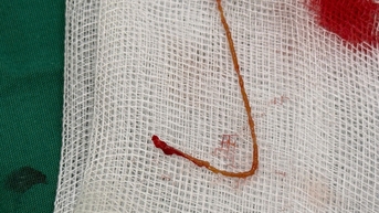 Người phụ nữ bị sỏi túi mật và áp xe gan do nhiễm giun sán